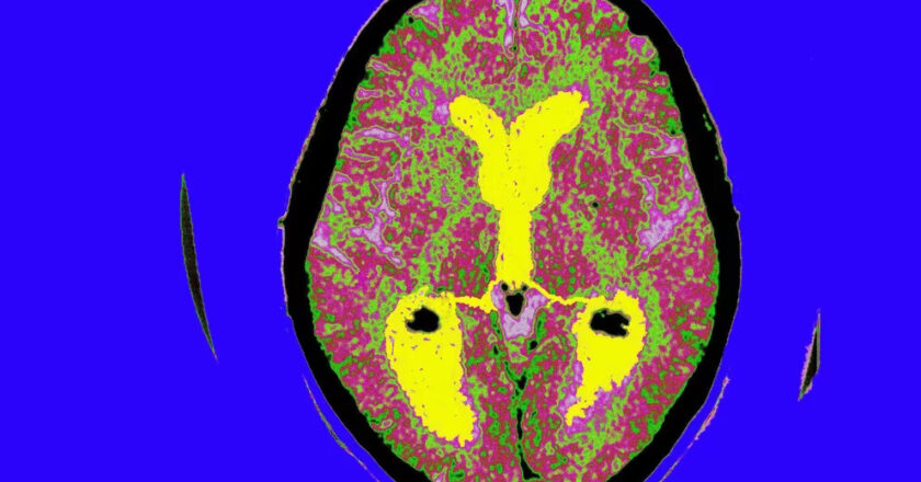 Resiliencia cognitiva, el concepto que puede modificar el pronóstico del Alzheimer para siempre y que tiene detrás a un científico argentino